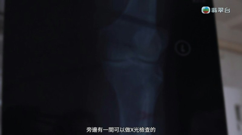 未有断骨。(电视截图)